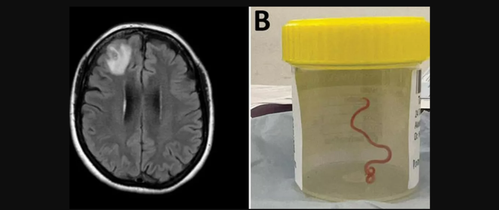 विश्वमै पहिलो पटक भेटियो मस्तिष्कमा जीवित कीरा