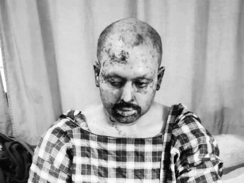 उर्लावारीका घाइते थप एक जनाको निधन, मृतकको संख्या पाँच पुग्यो